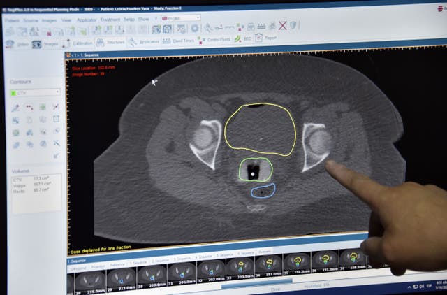 <p>A doctor points at a screen with the tests of a patient suffering from cervical cancer during her first session of 3D high rate brachytherapy </p>