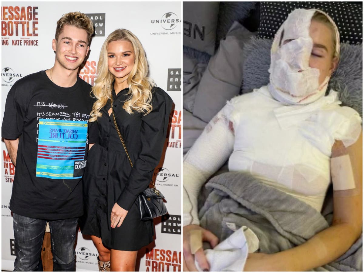 Aj Pritchard S Girlfriend Abbie Quinnen On Suffering Severe Burns I Thought That Was It For Me The Independent