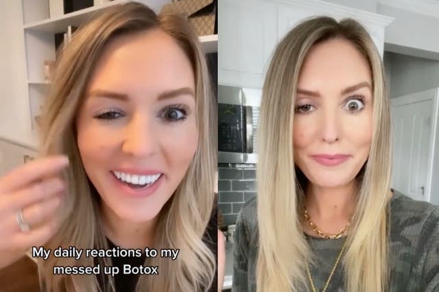 Influencer praised for being transparent about Botox incident 