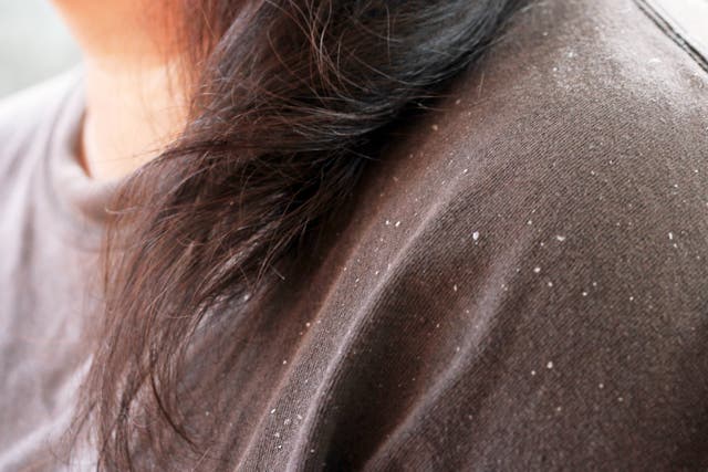 <p>Dandruff can be both fine little scales, or sometimes larger scales</p>