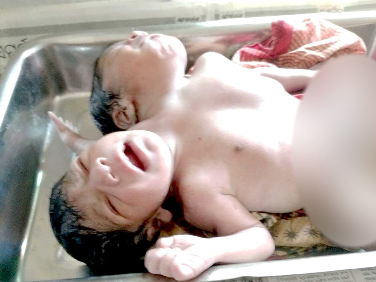 Conjoined twins with two heads, three arms and a torso, were born in Odisha, India on 12 April