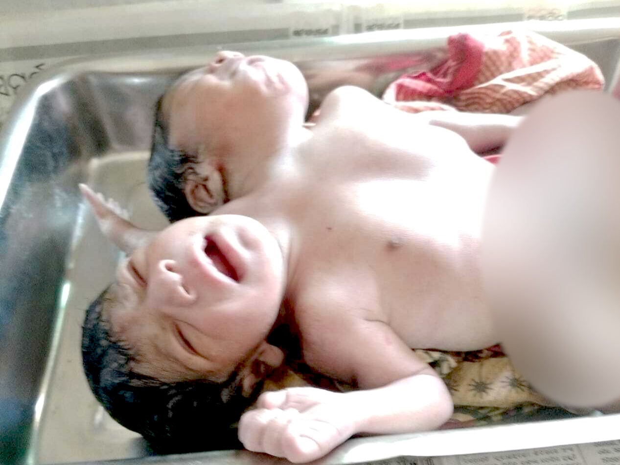 One in million' conjoined twins born in Odisha, India