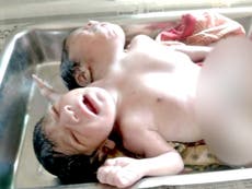 ‘One in million’ conjoined twins born in Odisha, India