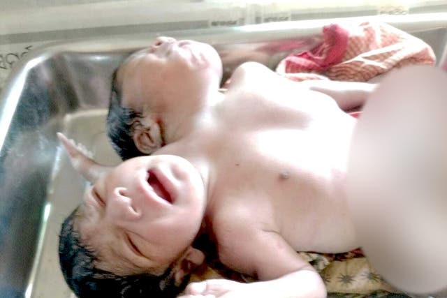 <p>Conjoined twins with two heads, three arms and a torso, were born in Odisha, India on 12 April</p>
