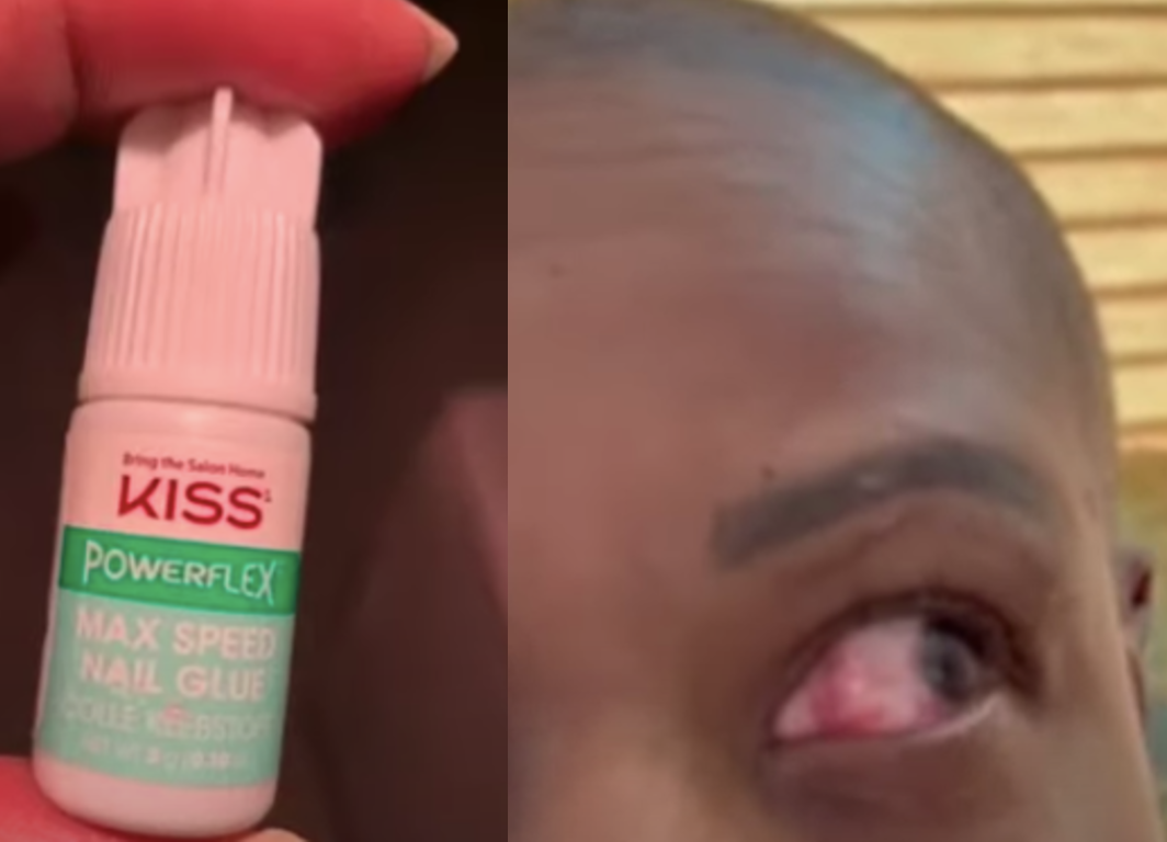Woman accidentally seals her own eye shut after mistaking glue for eye