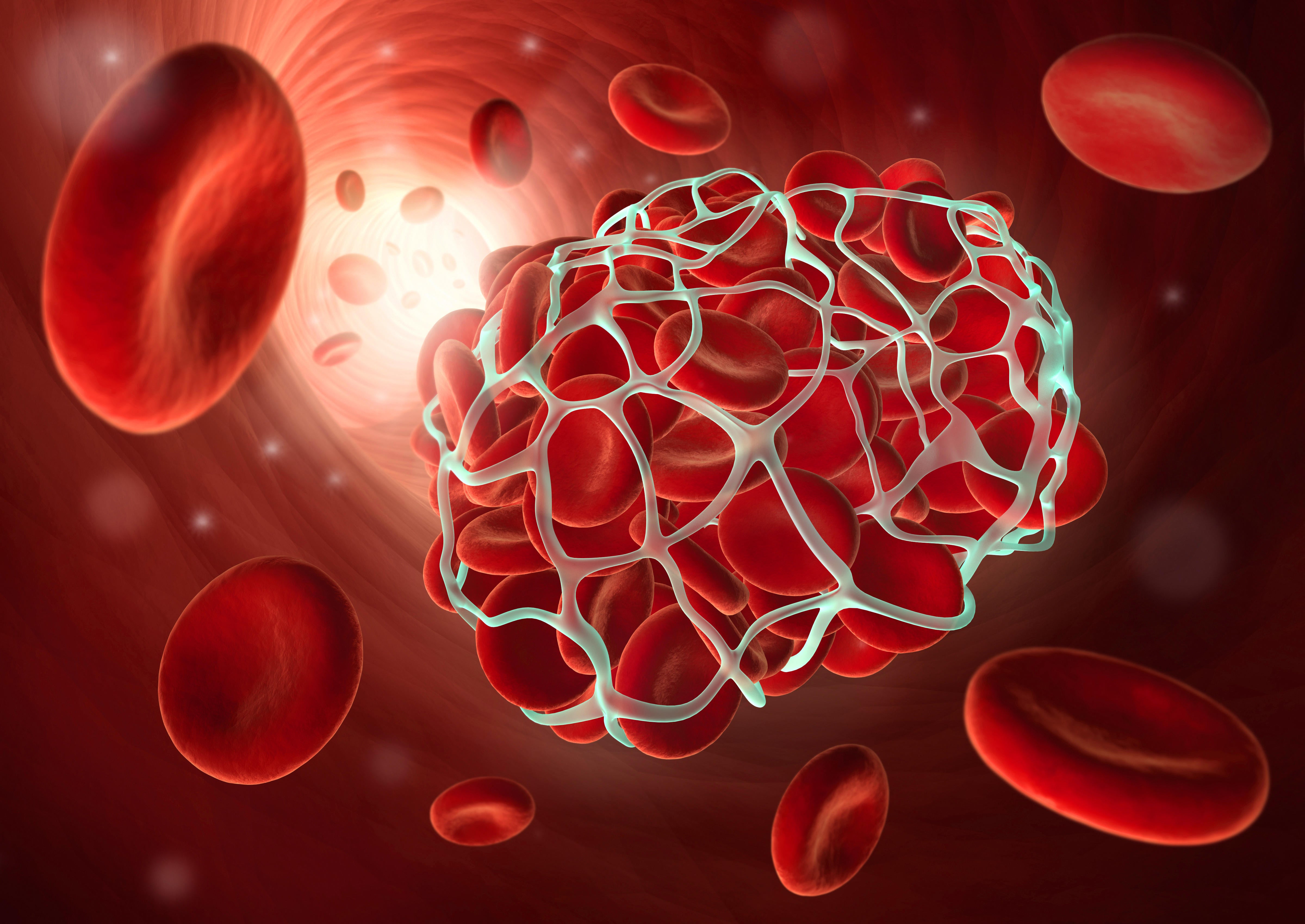 Medical illustration of a blood clot