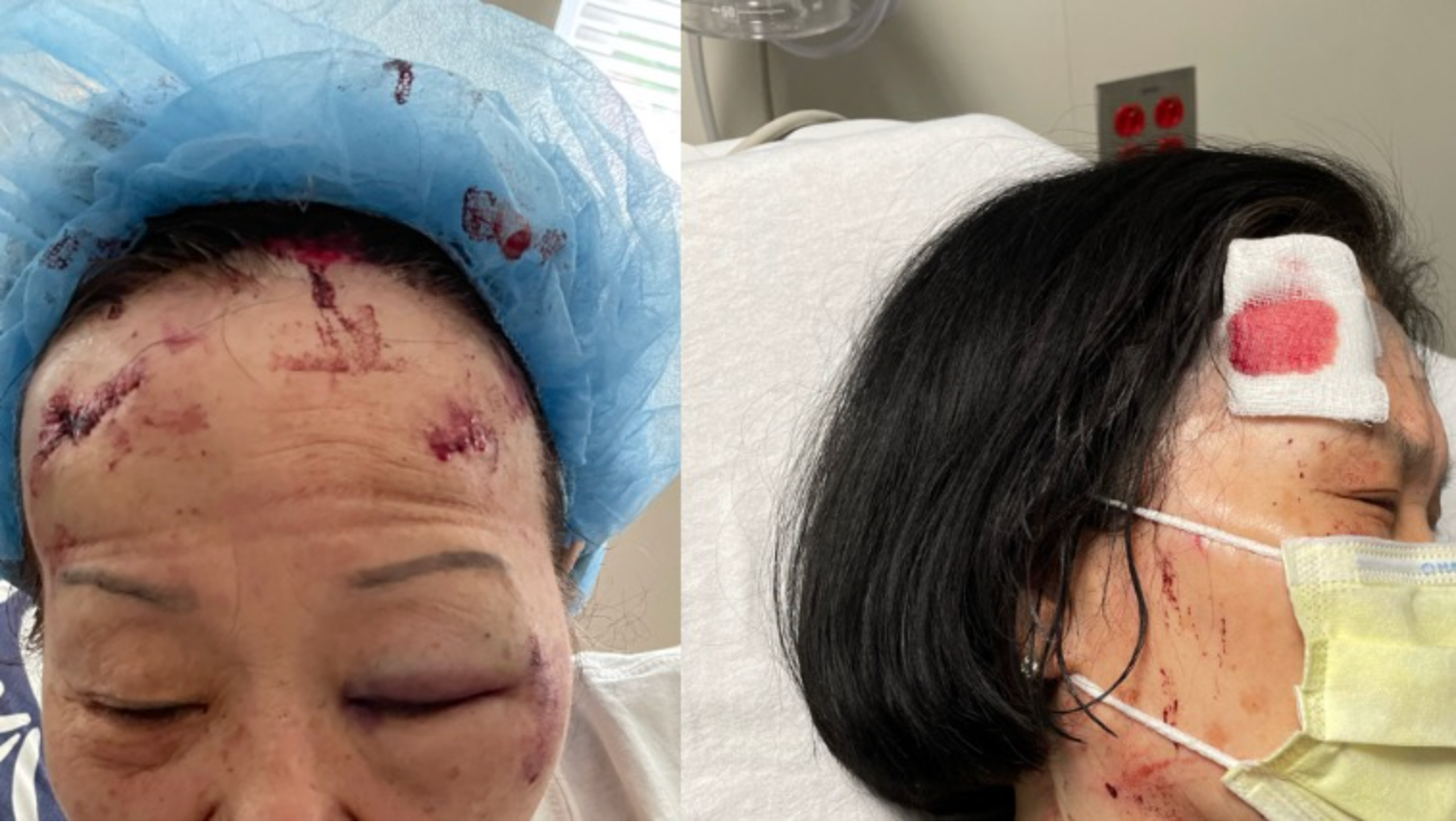 Two Asian women working at a liquor store in Baltimore sustained serious injuries after being attacked by a man with a cinder block.
