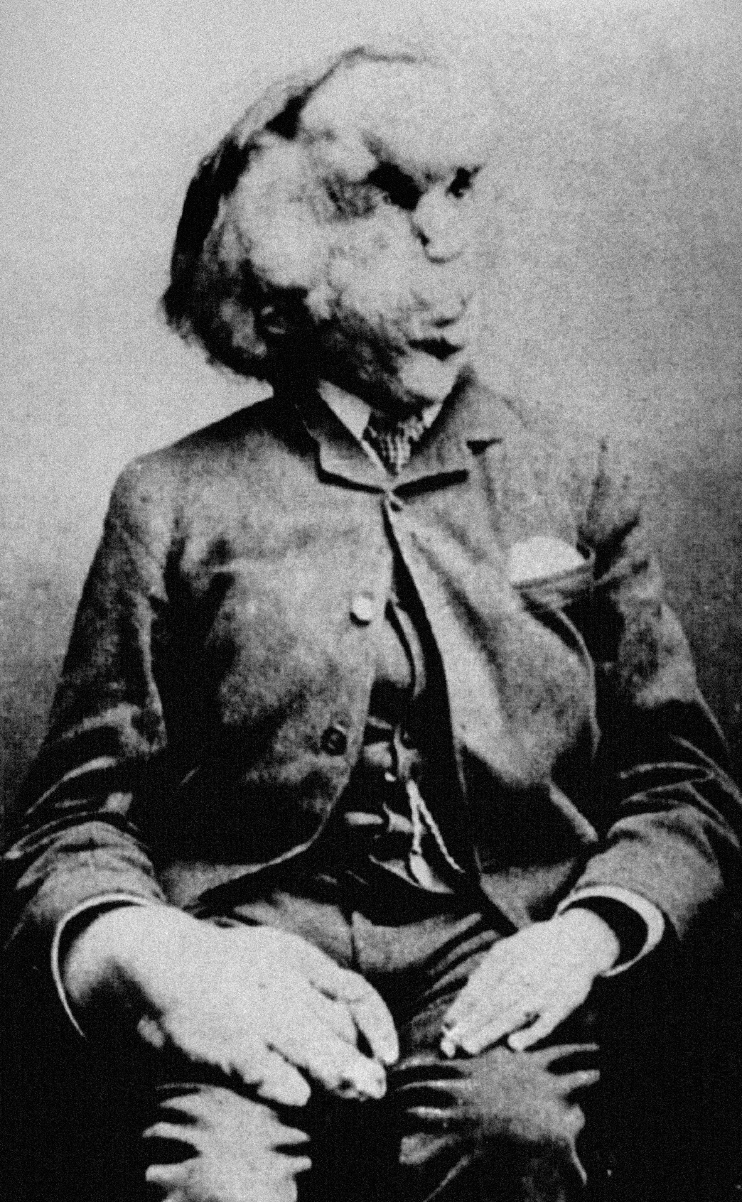 The Elephant Man, Joseph Merrick, whose appearance was probably a result of Neurofibromatosis