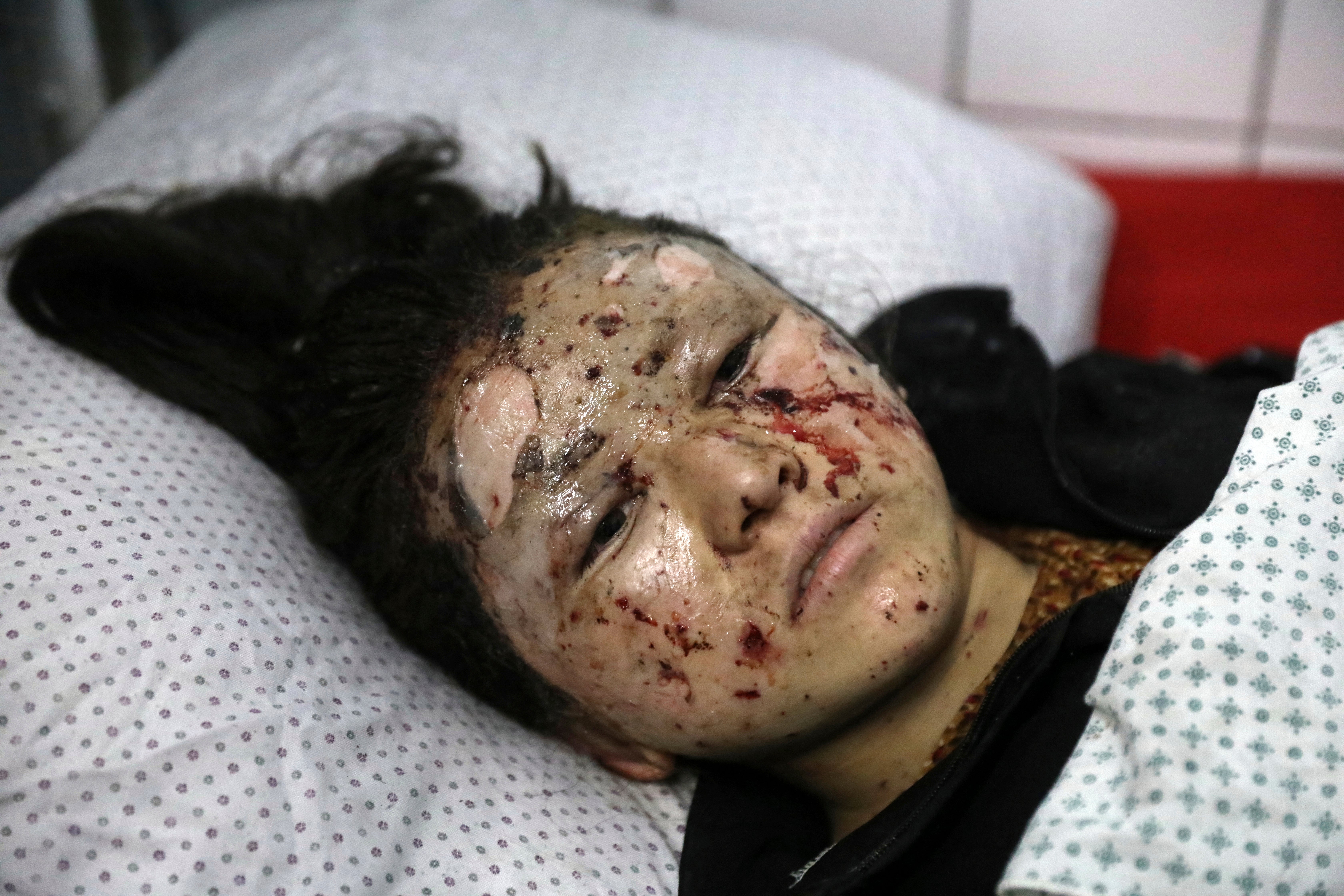 A schoolgirl is treated at a hospital after the bomb near a school in Kabul
