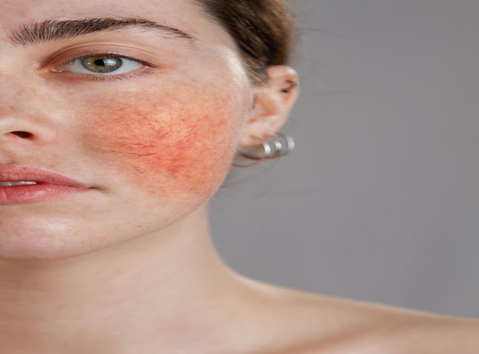 woman with rosacea on her cheeks.