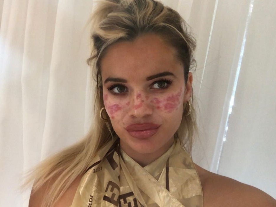 Australian Big Brother star Tilly Whitfield, 21, revealed she was hospitalised after trying an at-home TikTok beauty hack that went wrong