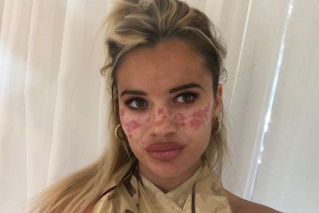 Australian Big Brother star Tilly Whitfield, 21, revealed she was hospitalised after trying an at-home TikTok beauty hack that went wrong