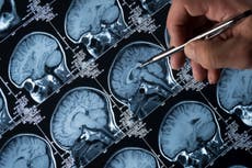 Oxygen therapy may slow Alzheimer’s, study finds