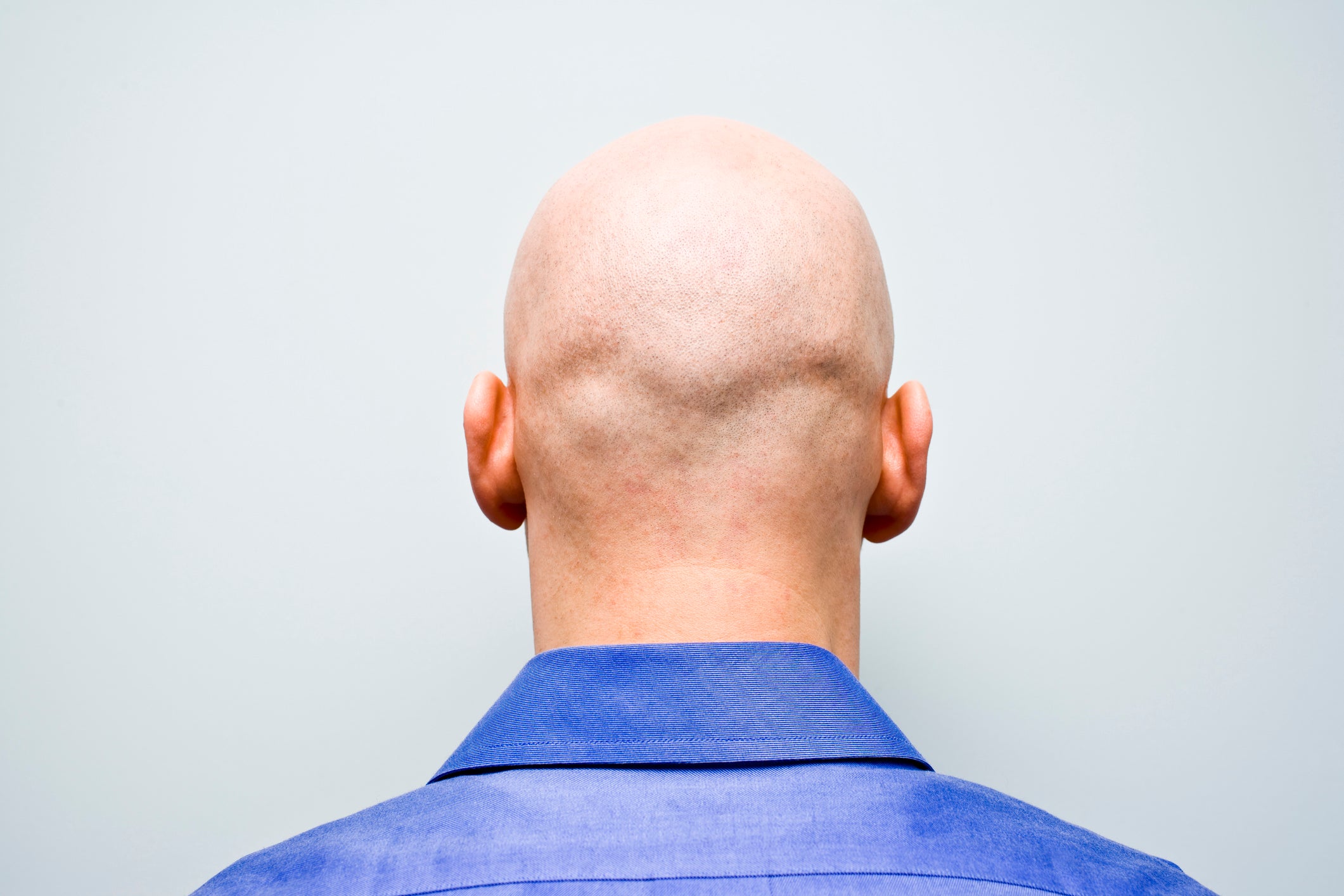 Calling man 'bald' is sex-related harassment, employment tribunal rules |  The Independent
