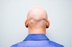 Calling man ‘bald’ is sex-related harassment, employment tribunal rules