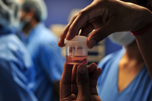 <p> A doctor displays a piece of infected tissue after surgery to remove mucormycosis from a patient in Allahabad, India</p>