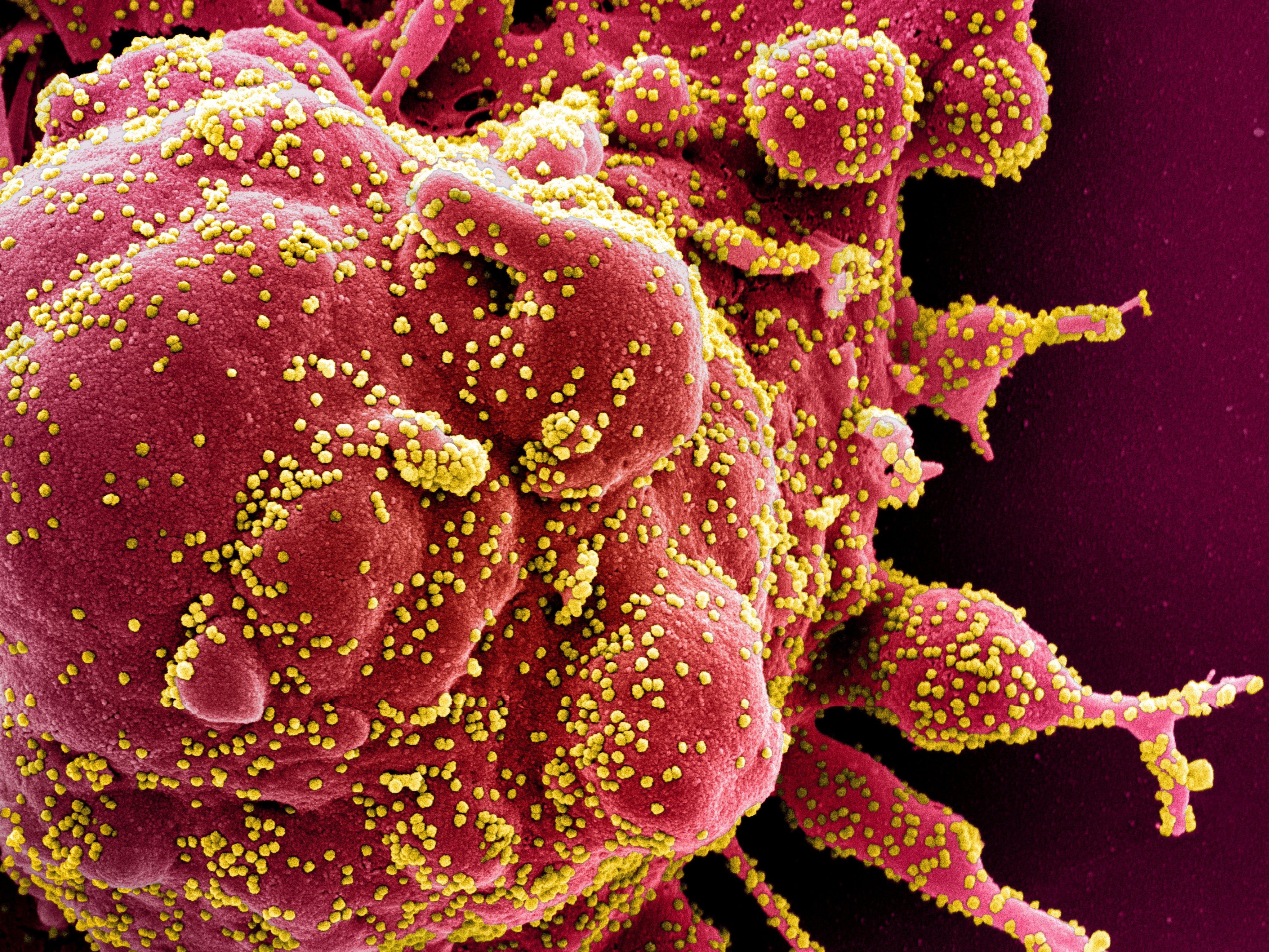 Coloured scanning electron micrograph of an apoptotic cell (red) infected with coronavirus particles (yellow) isolated from a patient sample