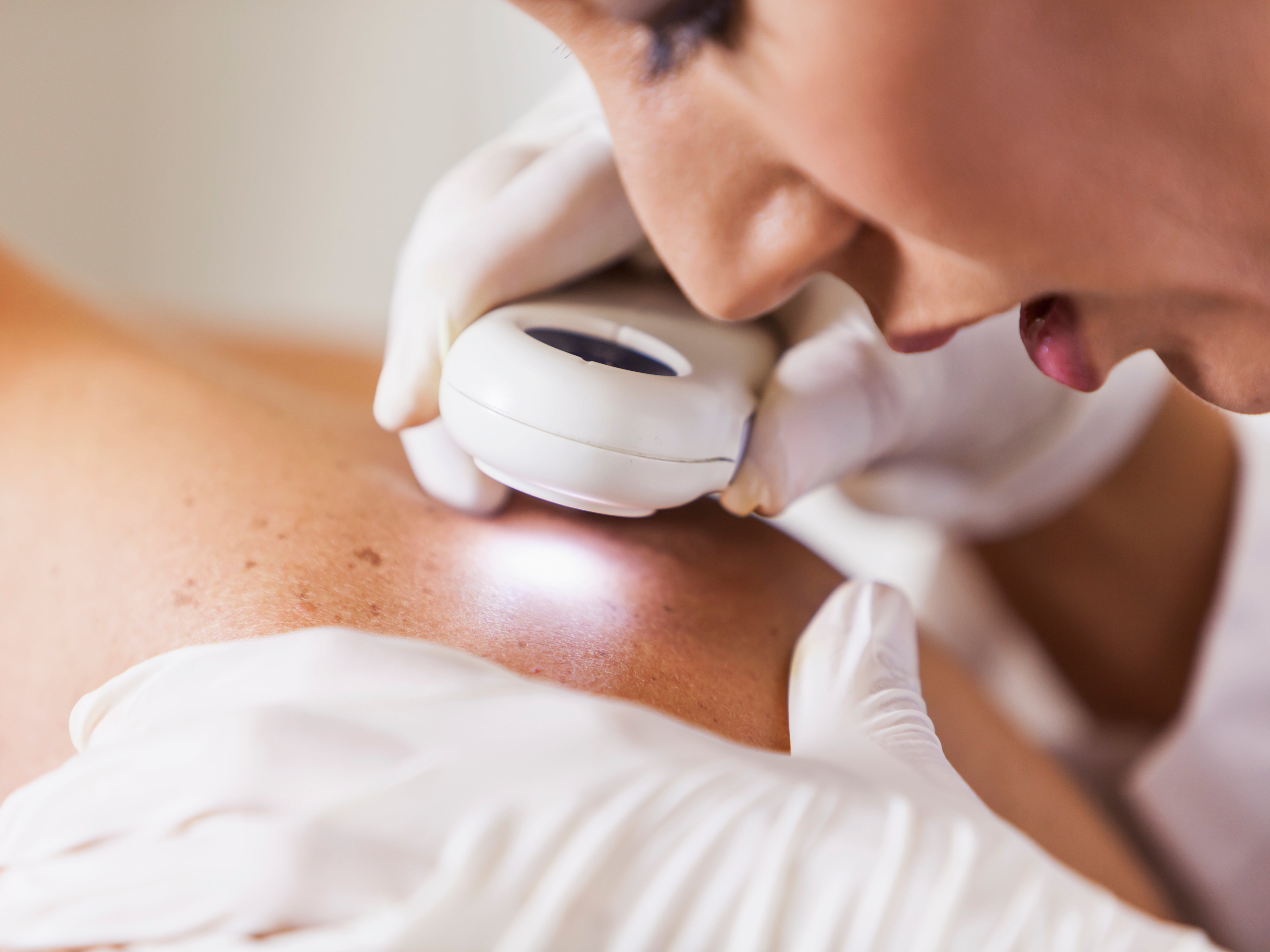 Melanoma rates have risen among UK males over a ten-year period, Cancer Research says