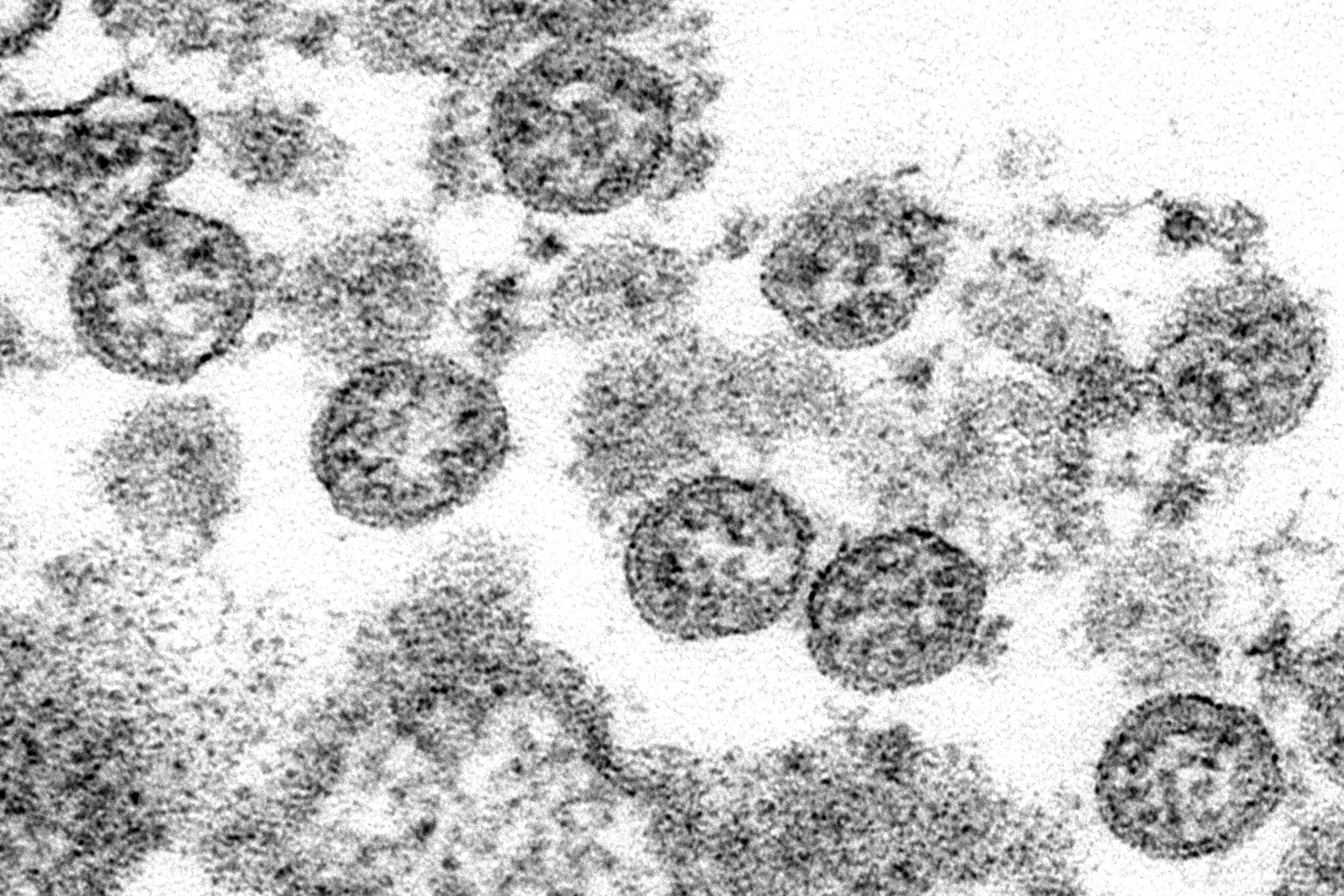 This 2020 electron microscope image shows the spherical coronavirus particles in what was believed to be the first US case of Covid