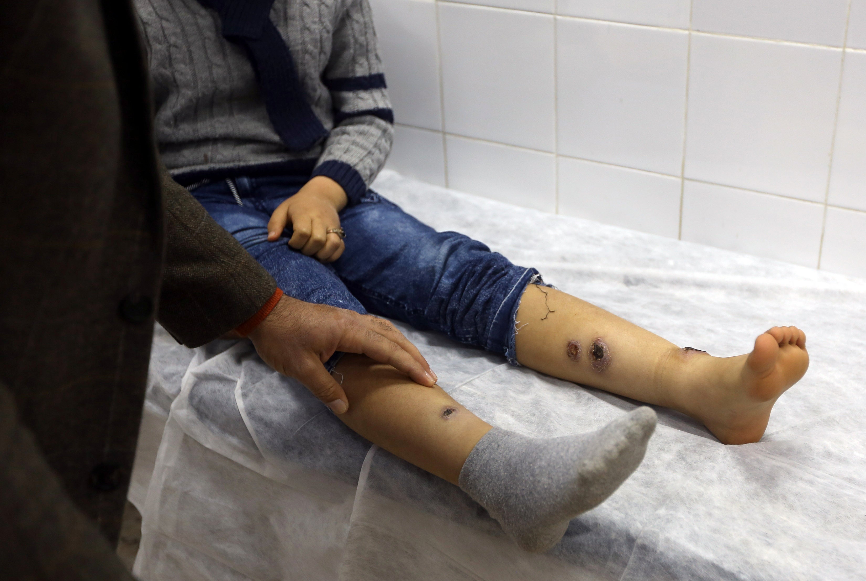 Boy receives treatment for Leishmaniasis at the Bir Al-Ostah Milad Hospital for Dermatology in the Libyan capital, Tripoli on 11 February, 2019