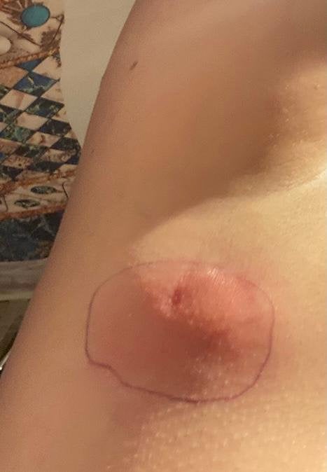 Abby Tannetta's lump under her arm after the spider bite