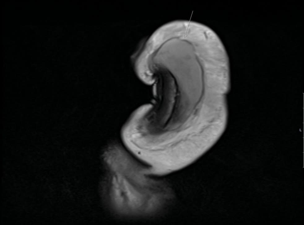 <p>The 40-year-old suffered from a 3cm vertical tear </p>