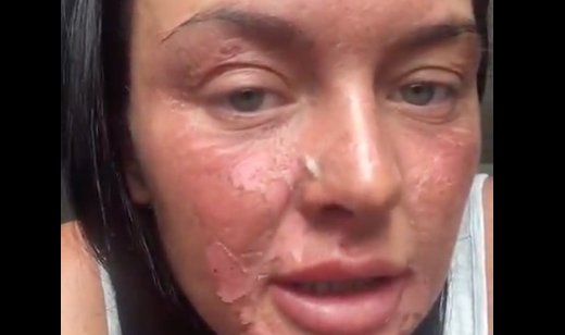 Chantelle Conway suffers ghastly burns after attempt to poach eggs using viral TikTok hack backfires