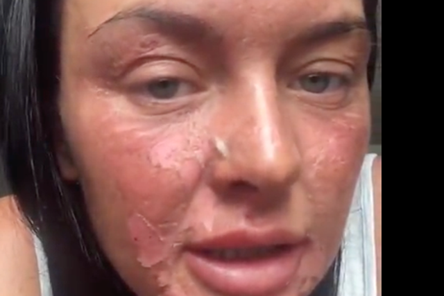 <p>Chantelle Conway suffers ghastly burns after attempt to poach eggs using viral TikTok hack backfires</p>
