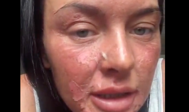 <p>Chantelle Conway suffers ghastly burns after attempt to poach eggs using viral TikTok hack backfires</p>