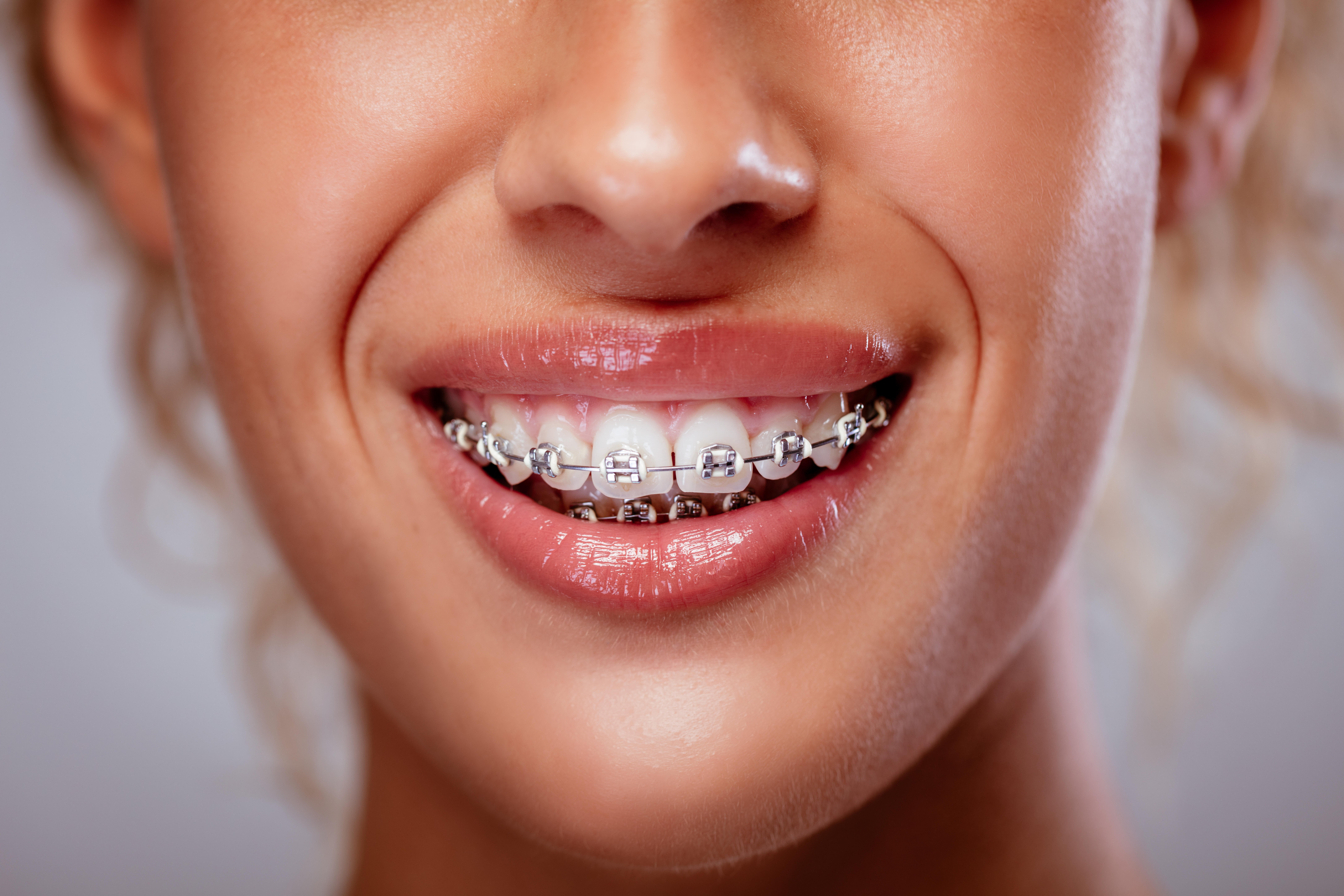 Braces can help with severe teeth crowding (Alamy/PA)