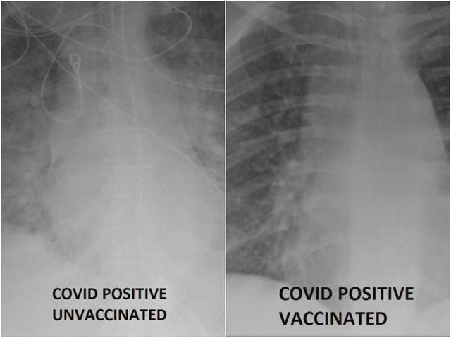 Un médico de St. Louis ha grabado imágenes de rayos X que muestran la importancia de recibir la vacuna Covid-19.
