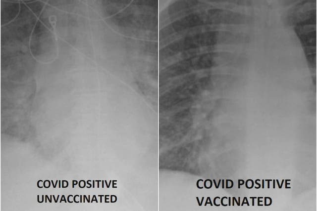 <p>A St Louis doctor has chared X-ray images showing the importance of getting the Covid-19 vaccine. </p>