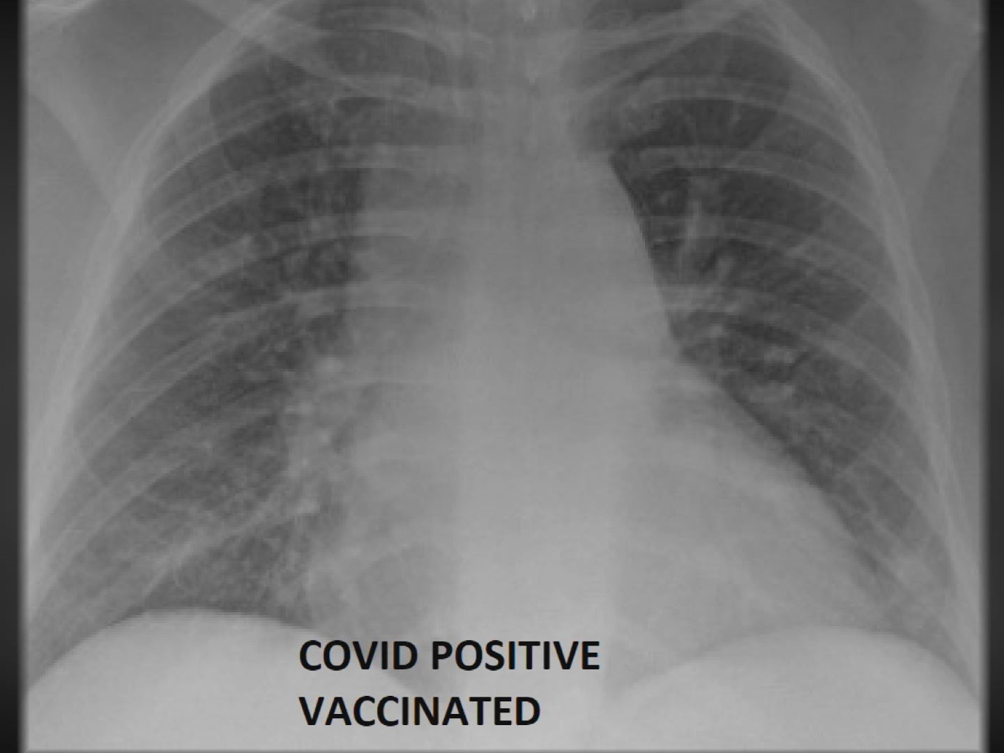 The x-ray image of the vaccinated individual infected with Covid-19 is a rare breakthrough case – less than one per cent of vaccinated people have been infected.