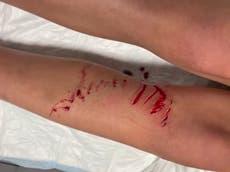 Shark attacks girl in Maryland but authorities insist waters are safe