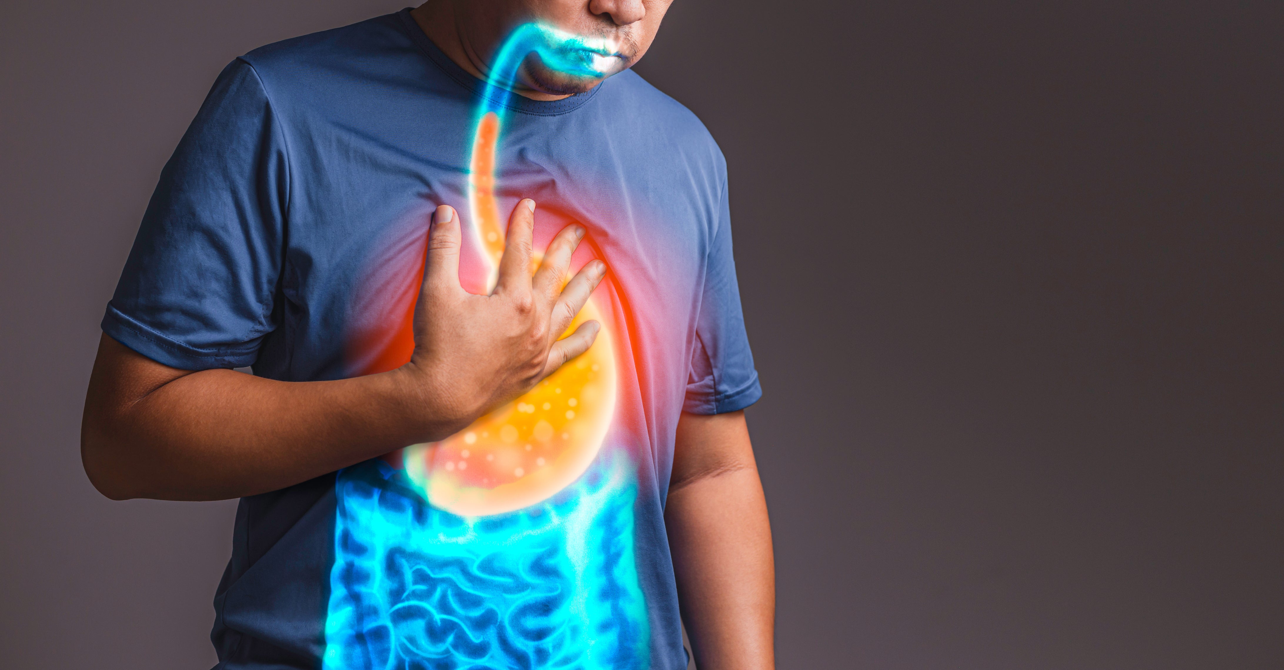 It can also involve reflux or waterbrash