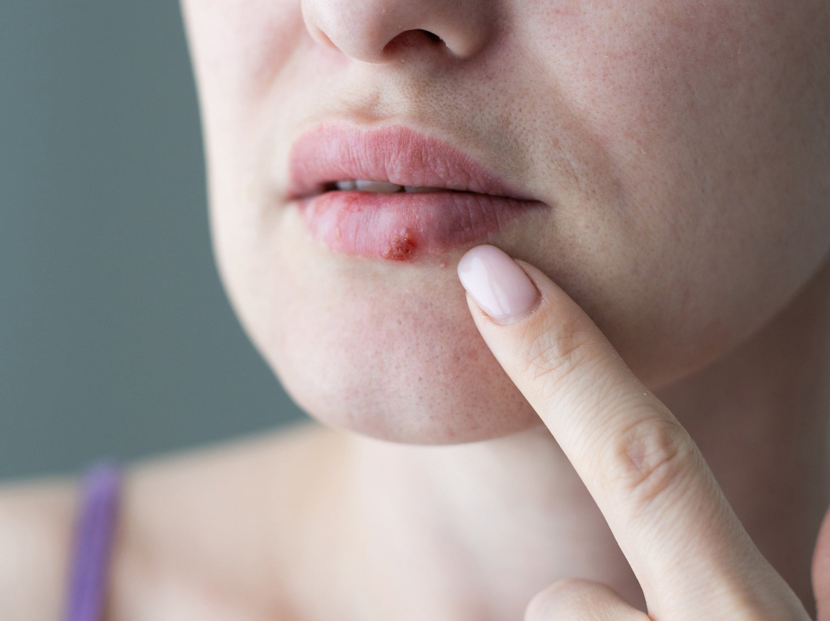 Cold sores are caused by the herpes virus