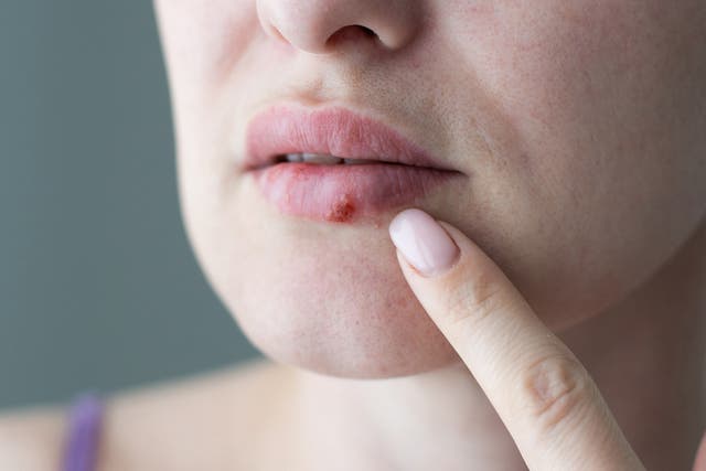 <p>Cold sores are caused by the herpes virus </p>