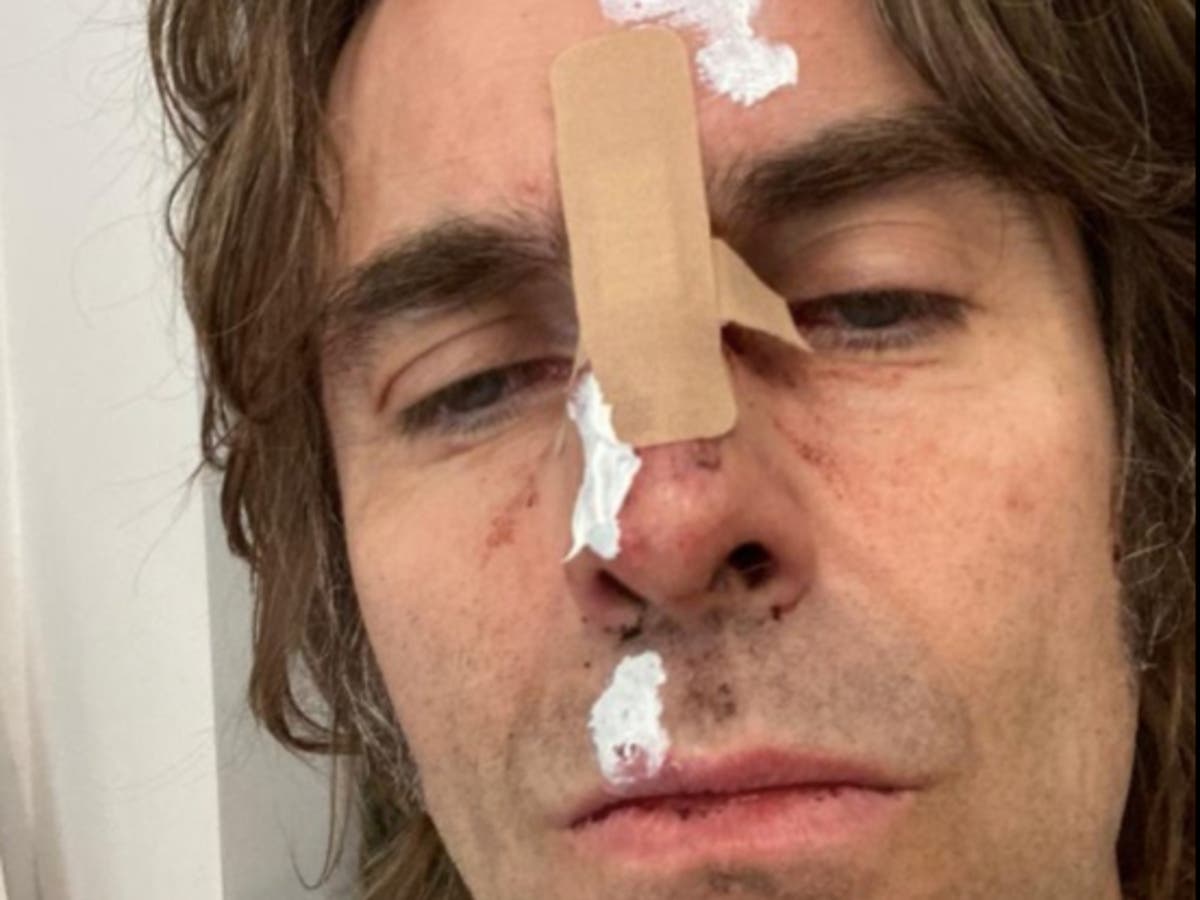 Liam Gallagher suffers injuries after &lsquo;falling out of helicopter&rsquo; following Isle of Wight headline set