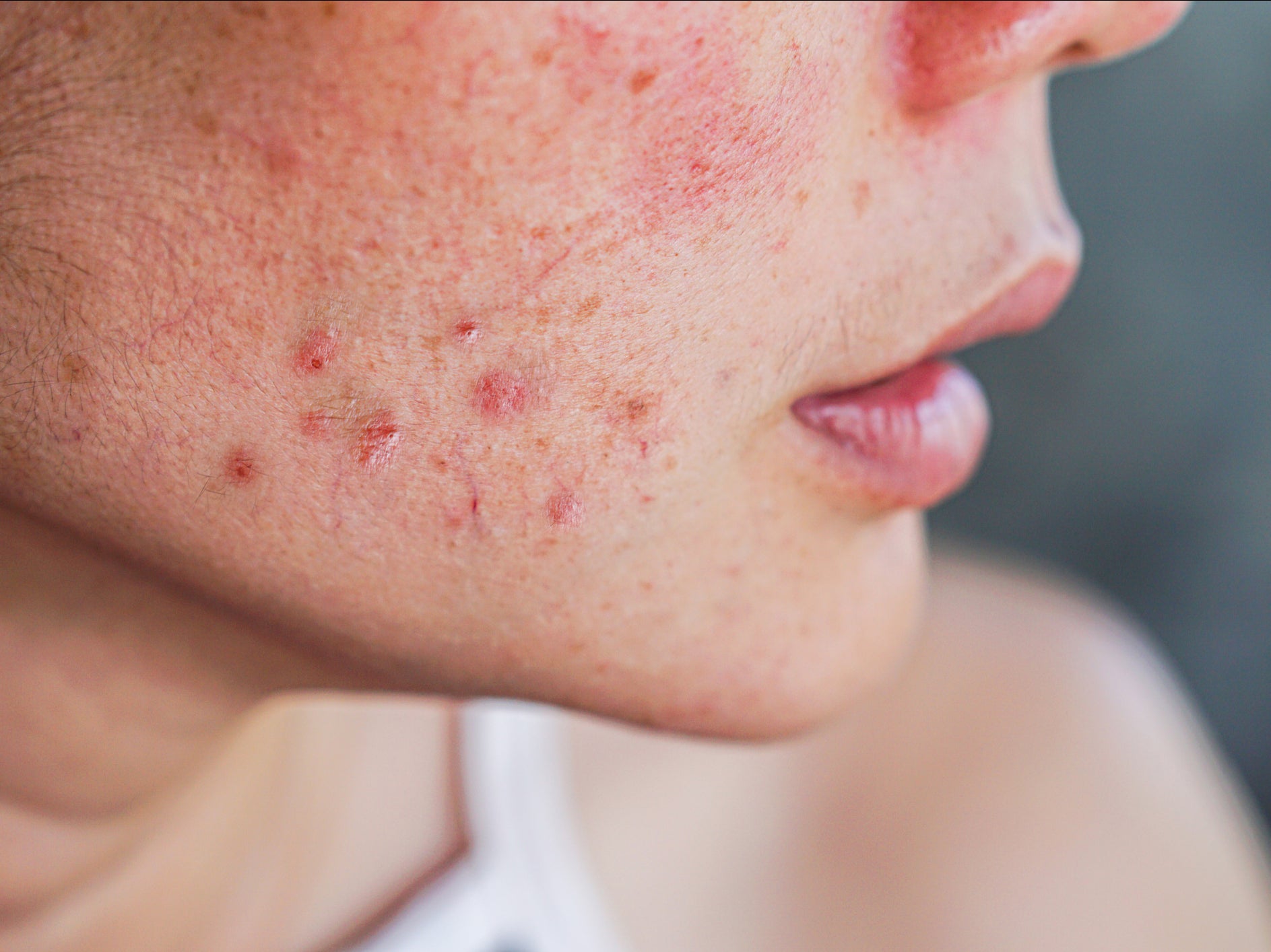 Stronger retinoid treatments that target acne will require a prescription