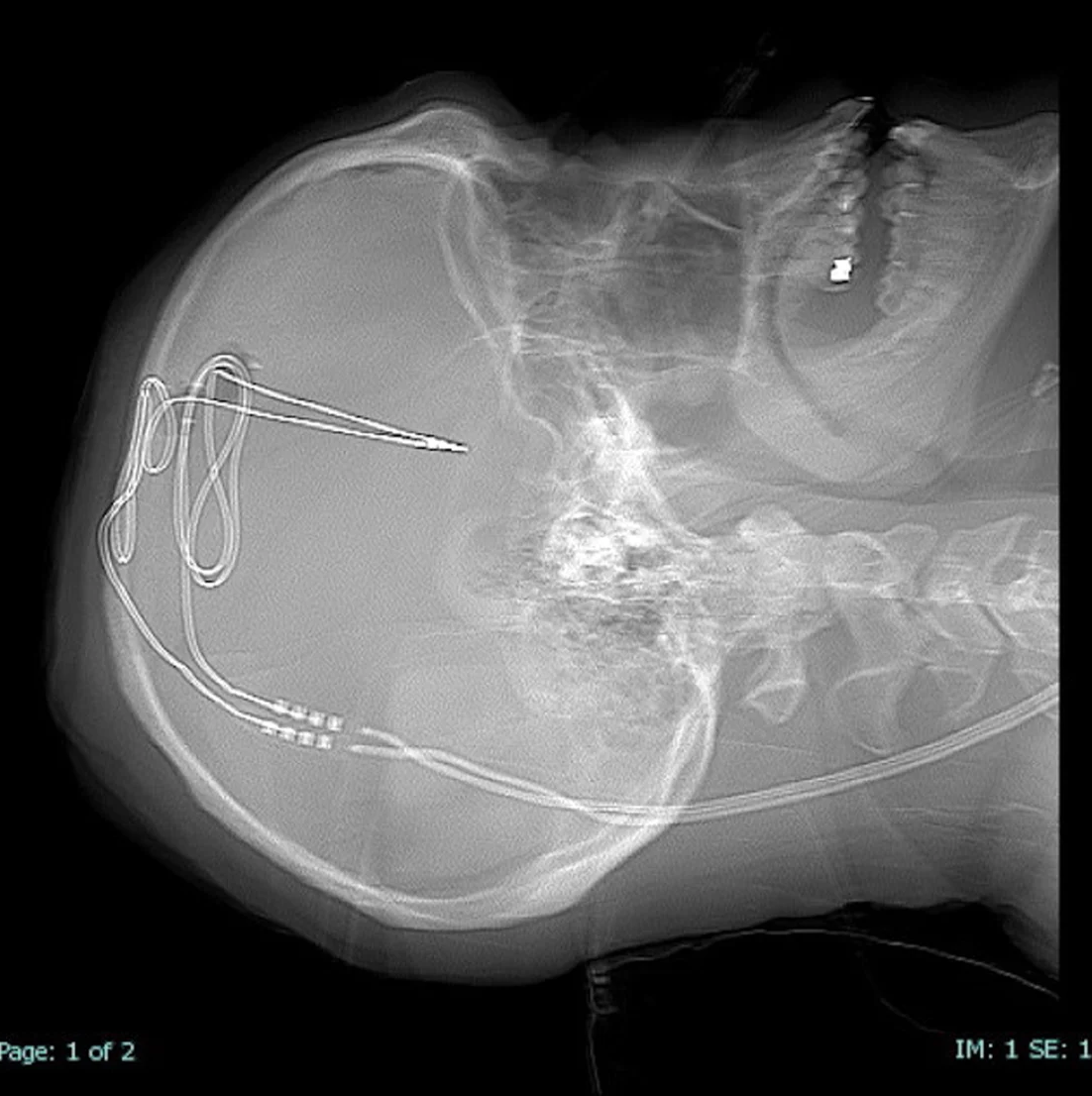 <p>Deep brain stimulation, which involves implanting tiny electrodes that send pulses to the brain’s pleasure centre, is being used to treat opioid addicts</p>