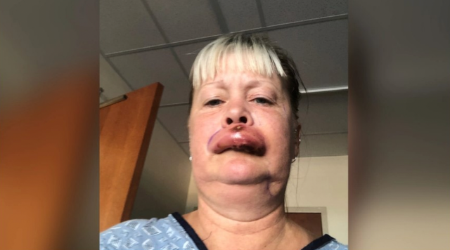 <p>Sherri Maddox was bitten by a brown recluse spider.</p>