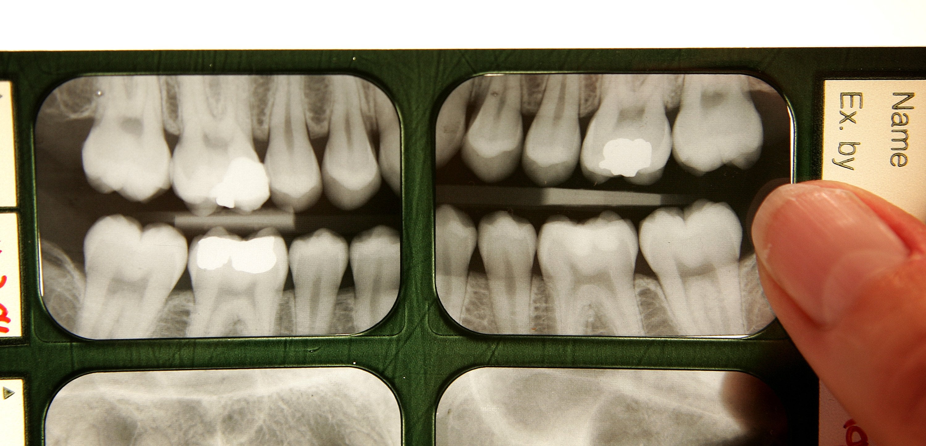 Dental X-rays are displayed on a light box