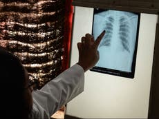 Tuberculosis deaths rise for first time in over a decade due to impact of Covid pandemic, says WHO