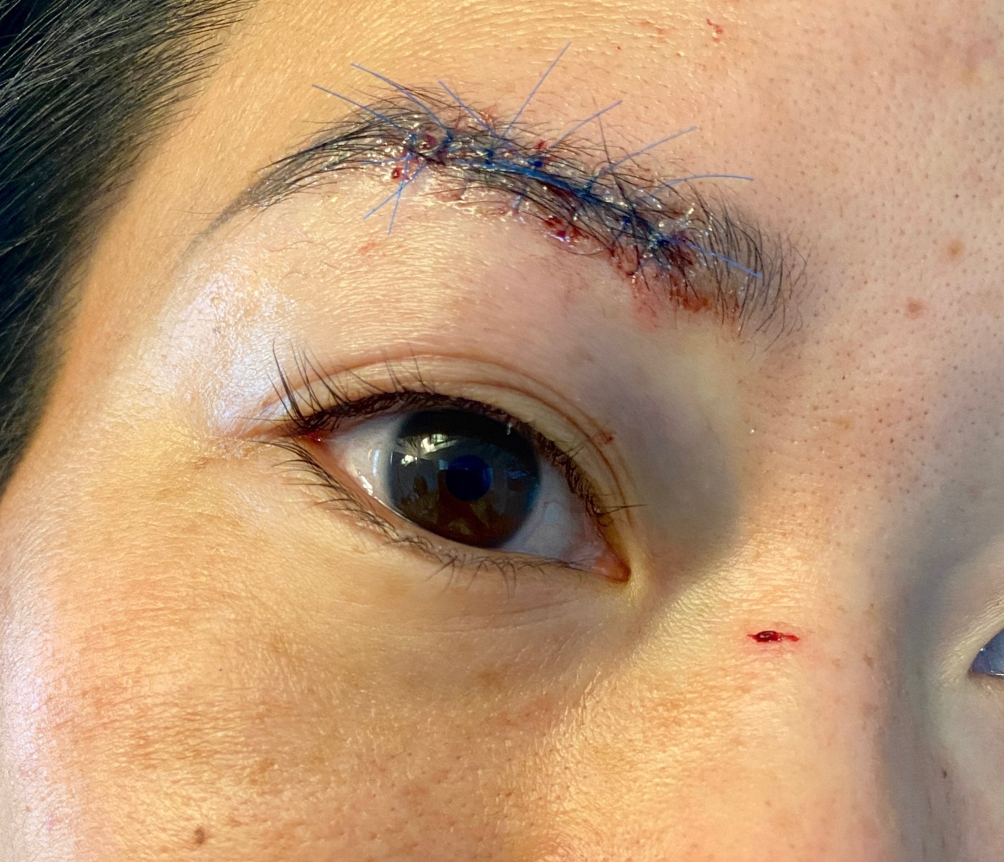 Ms Yi received several stitches after being struck above her right eye