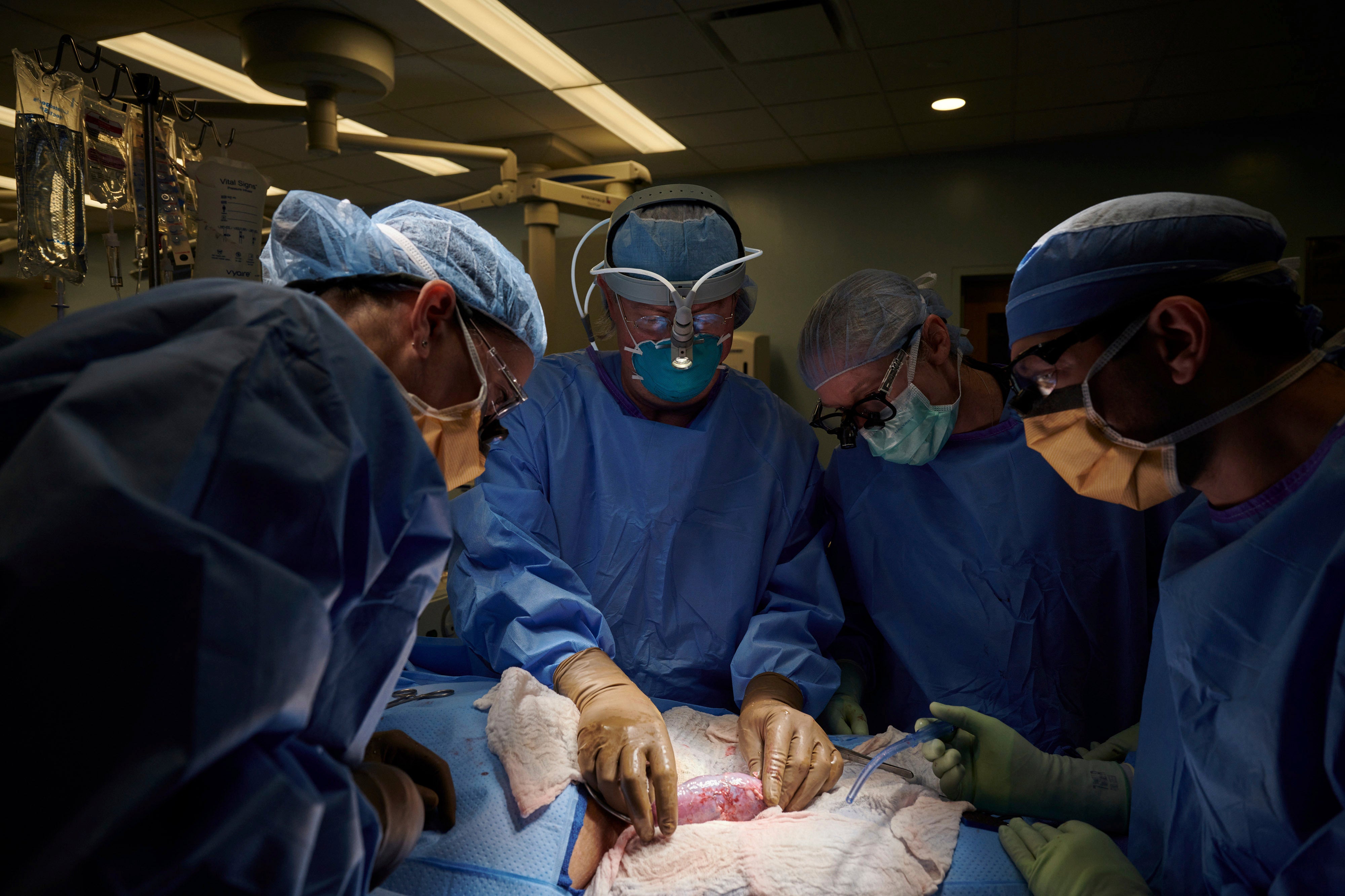 In this September 2021 photo provided by NYU Langone Health, a surgical team at the hospital in New York examines a pig kidney attached to the body of a deceased recipient for any signs of rejection