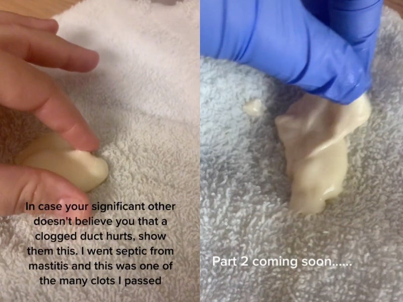 Woman shares video of clots she had to pump out after developing mastitis during breastfeeding