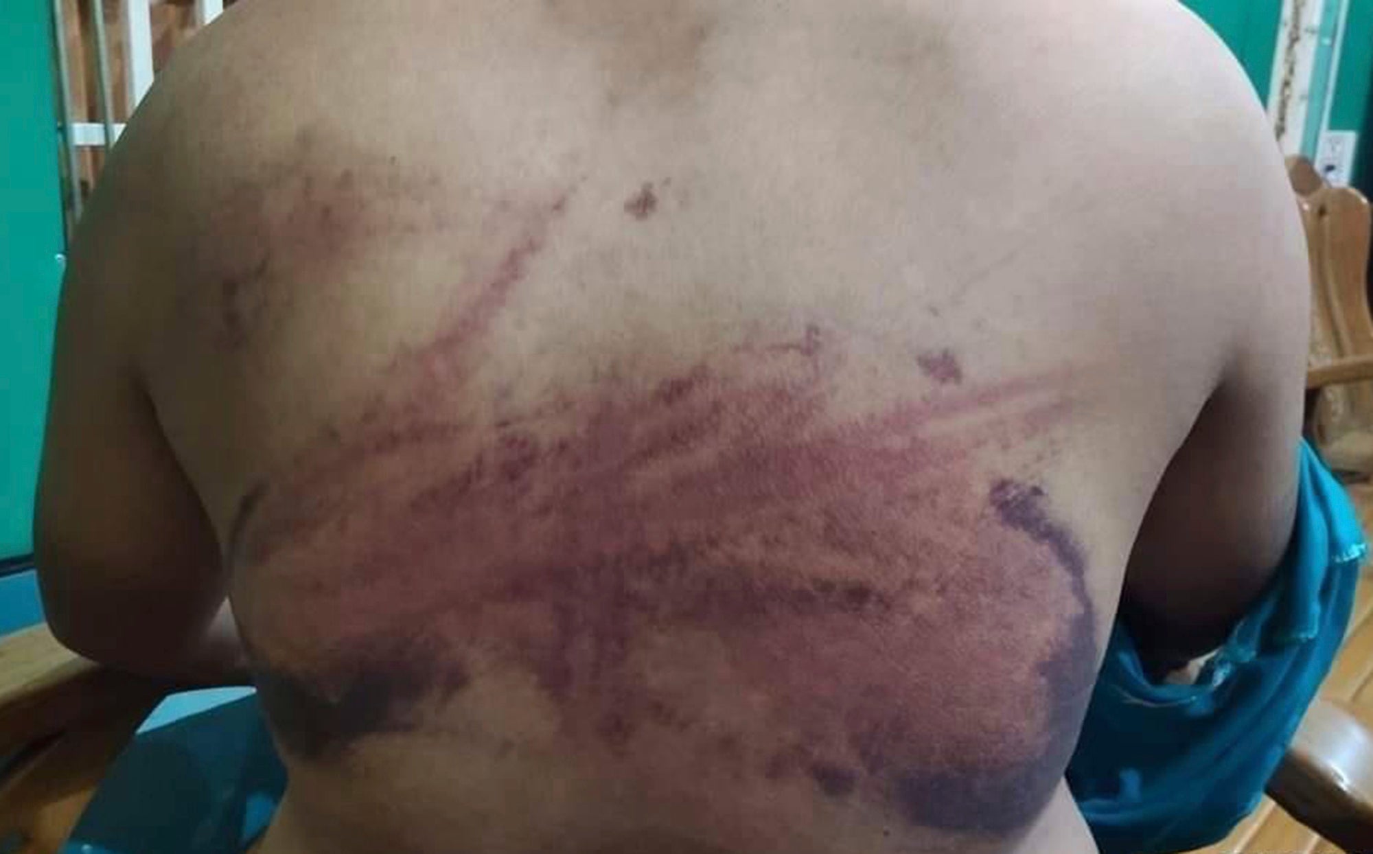 A man in his 20s allegedly tortured by Myanmar's military during an interrogation session in March 2021
