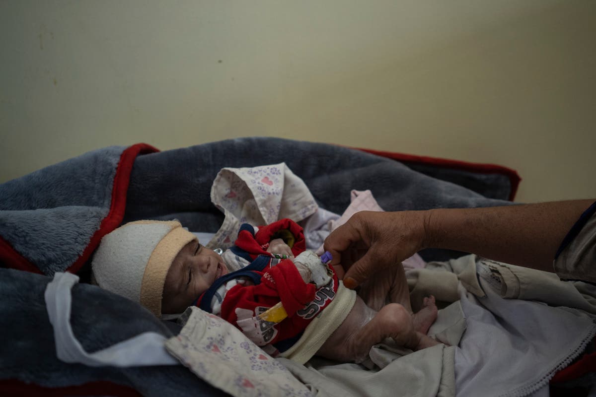 Emaciated children in Kabul hospital point to rising hunger