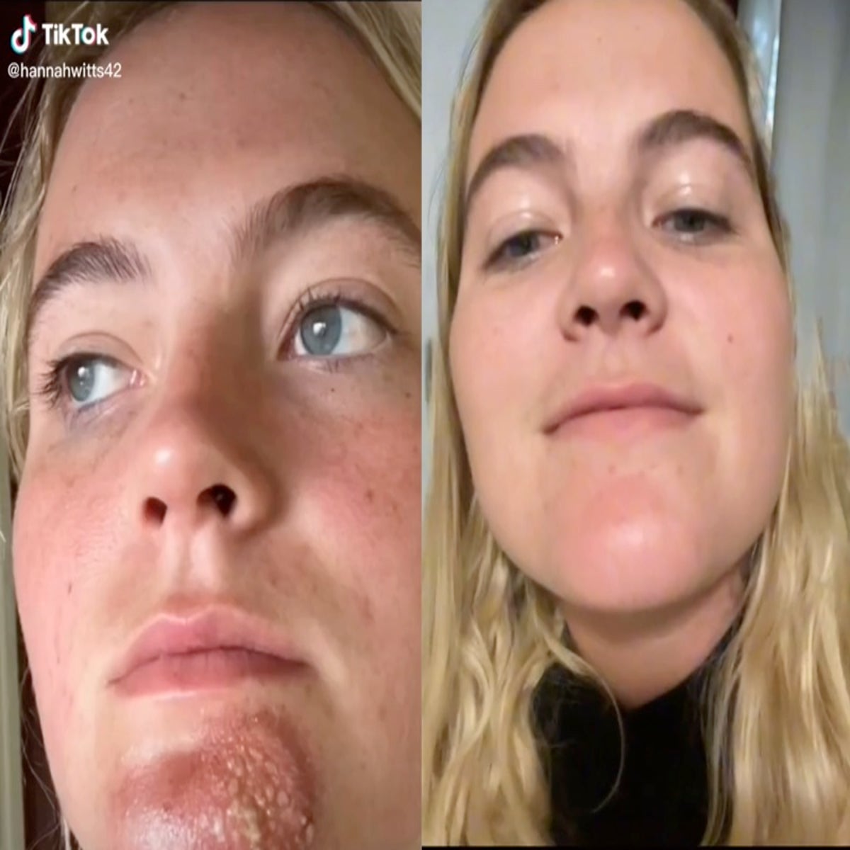 Woman shows chin infection reportedly caused by kissing a man with beard  stubble | The Independent