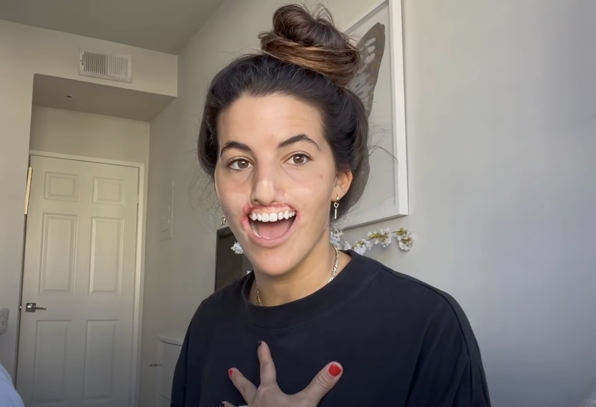Influencer reveals she is undergoing first reconstructive surgery after dog attack